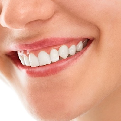 WHAT IS A HOLLYWOOD SMILE? 