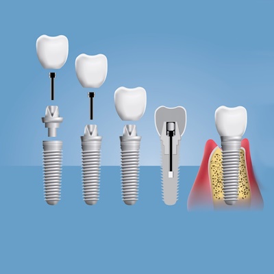 HOW MANY VISITS TO THE DENTIST DO I NEED FOR DENTAL IMPLANTS?